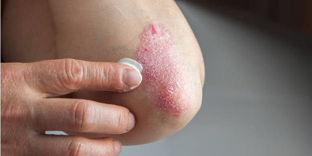 Traiter le psoriasis pour préserver la qualité de vie