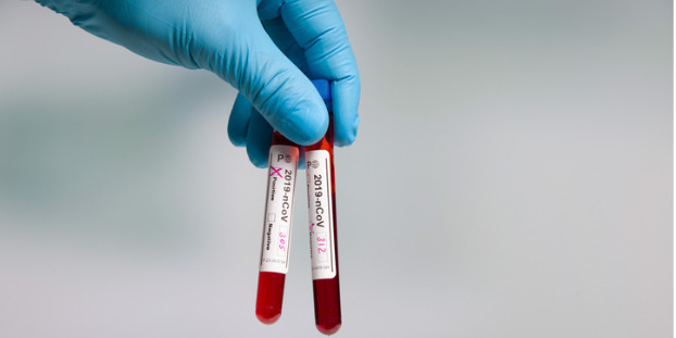 Le potentiel des tests sérologiques de 2e génération