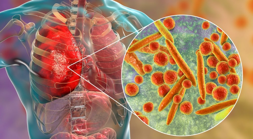 Tout ce que les pharmaciens doivent savoir sur la montée des infections à Mycoplasme