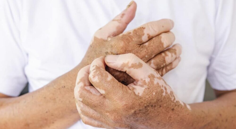 Un traitement innovant pour le vitiligo : OPZELURA©