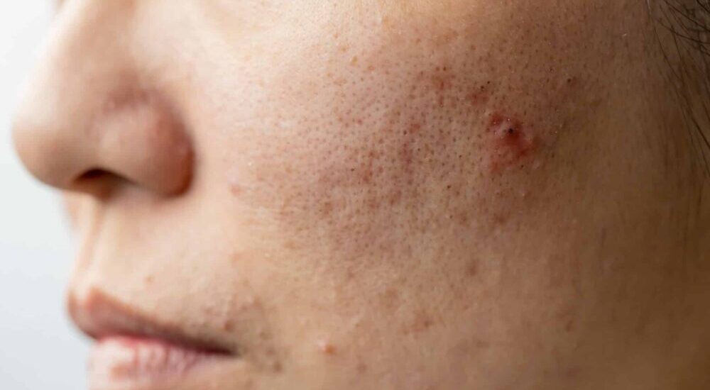 « Vous avez quelque chose contre l’acné ? » Guide pratique des conseils à prodiguer
