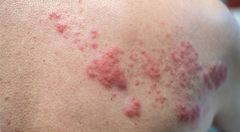 Vaccin Shingrix : bientôt remboursé ?