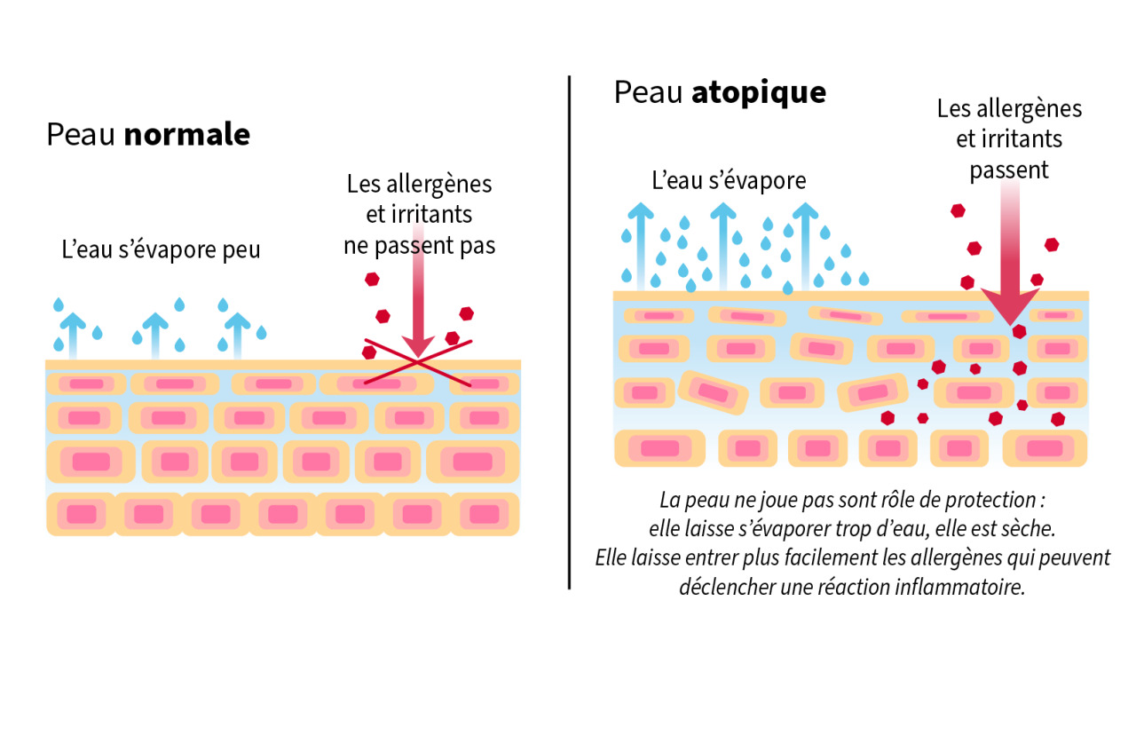 Peau normale versus peau atopique